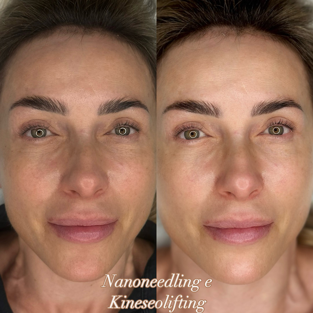 Microneedling