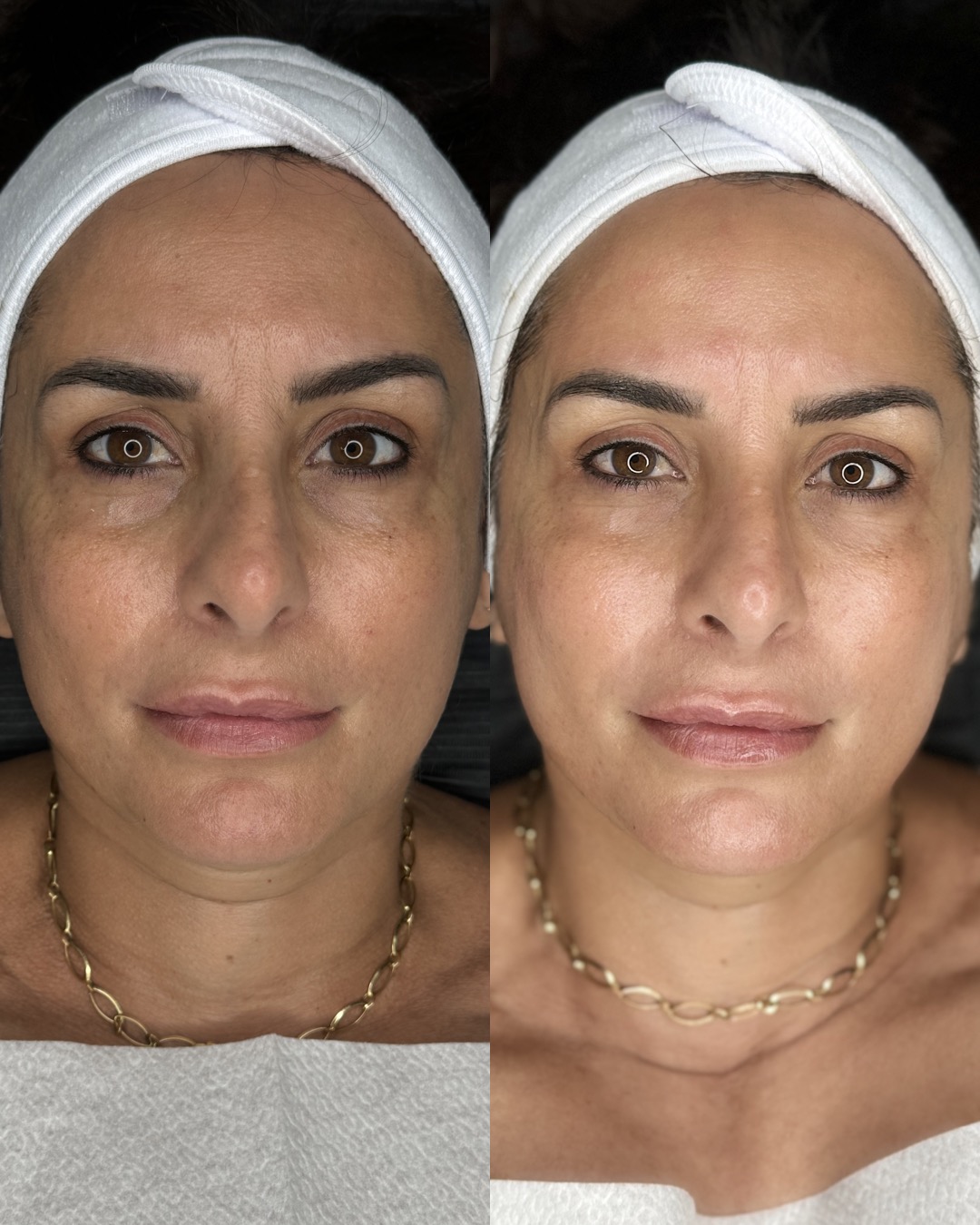 Microneedling